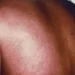 Act now to prevent Marburg virus outbreak