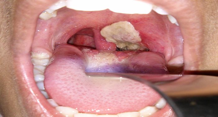 Diphtheria spreads to Lagos, NCDC monitors Osun, Yobe