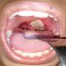 Diphtheria spreads to Lagos, NCDC monitors Osun, Yobe